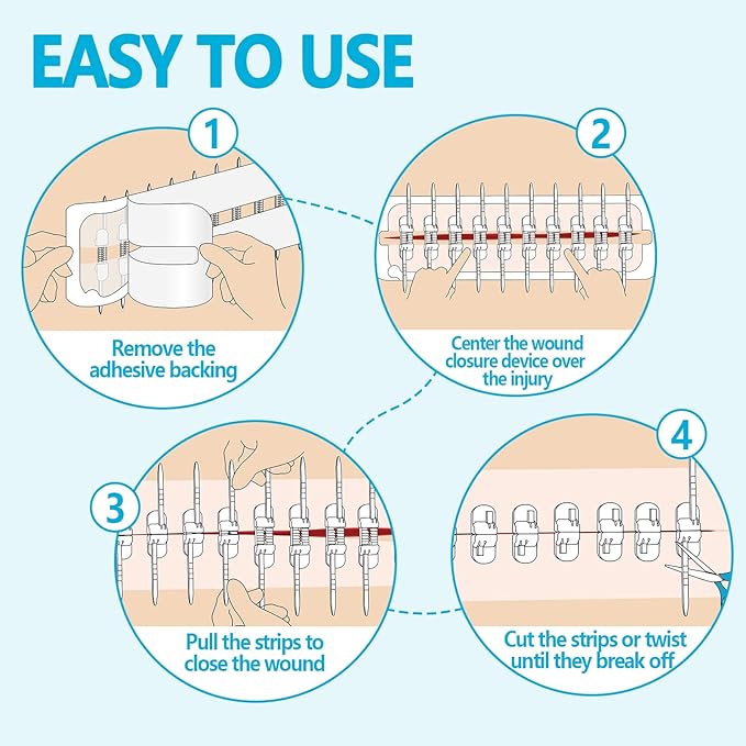 Large Butterfly Bandages for Extra Large Wounds | Steri Strips Wound Closure - Surgical-Grade Stitchless Laceration Repair & Rapid Hemostasis, Emergency First Aid Care